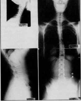 X-rays from Dr Braile, a Chiropractor in West Marietta GA