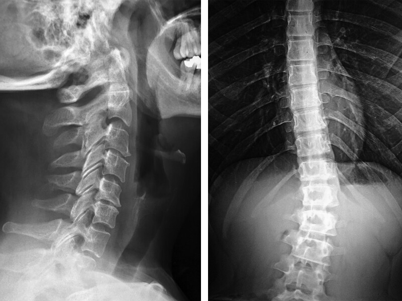 Spinal x-rays